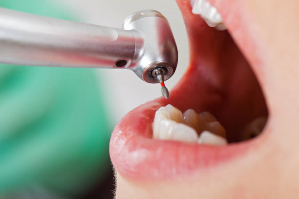 Best Emergency Tooth Extraction in Dacula, GA
